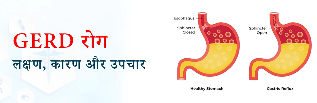  GERD रोग: लक्षण, कारण और उपचार